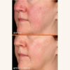 Dr Dennis Gross Vitamin C Lactic 15% Firm & Brighten Serum | Before and after 12 weeks